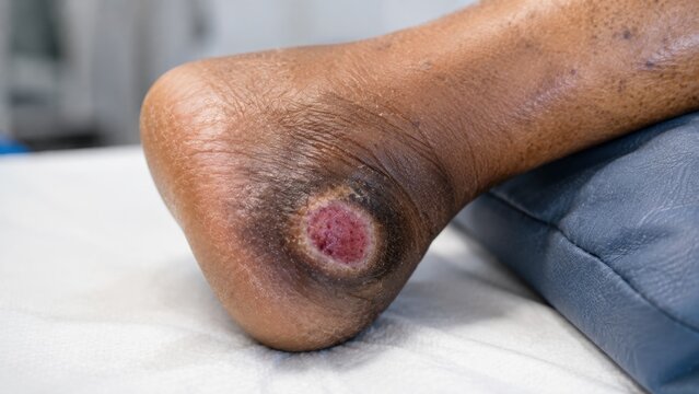 Diabetic Foot Ulcer Care Close-Up of Heel Pressure Wound on Dark Skin with Granulation Tissue and Necrotic Border Clinical Dermatology Documentation
