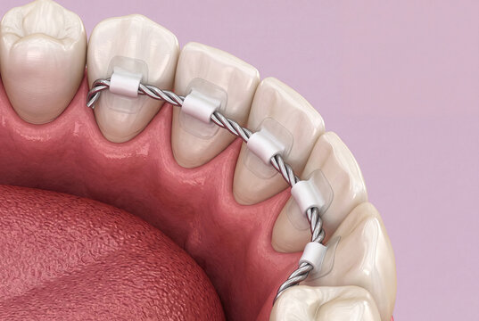Fixed Orthodontic Retainer on Lower Front Teeth Showing Twisted Wire Bonded with Composite Attachments for Dental Alignment Maintenance
