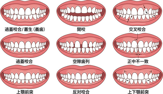 Educational dental vector chart displaying various malocclusion types human teeth alignment issues and orthodontic correction alignment diagnoses