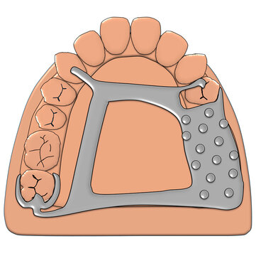 Removable Partial Denture Beaded Metal Framework Cast Metal RPD Dental Illustration