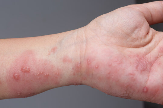 Shingles, Zoster or Herpes Zoster symptoms on arm and hand