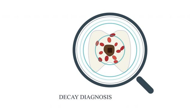 Tooth decay diagnosis animation, bacteria and inflammation magnified under lens