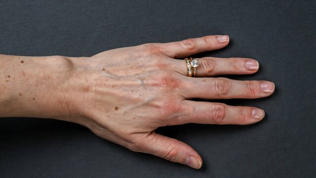 Human hand with visible ganglion cyst on wrist against dark background, ganglion