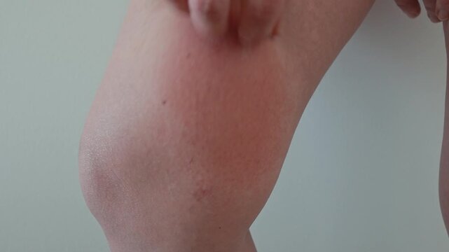 Inflamed insect bite on leg with redness and skin irritation