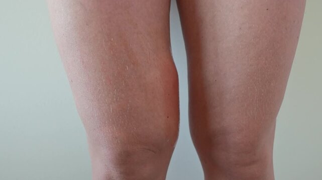 Inflamed insect bite on leg with redness and skin irritation
