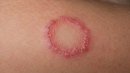 Fototapeta premium Ringworm fungal infection with circular rash on skin