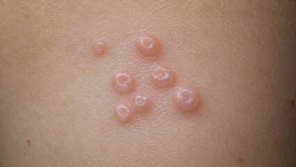 Fototapeta premium Macro shot of molluscum contagiosum papules on skin