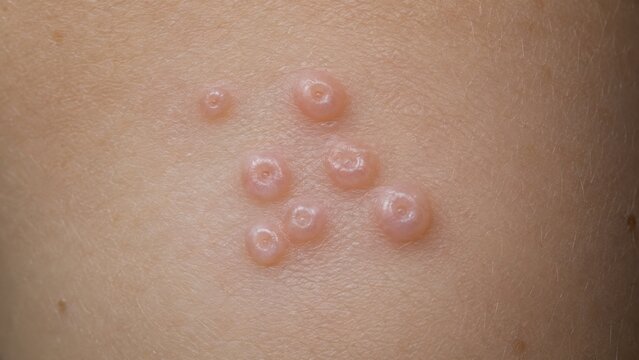 Macro shot of molluscum contagiosum papules on skin