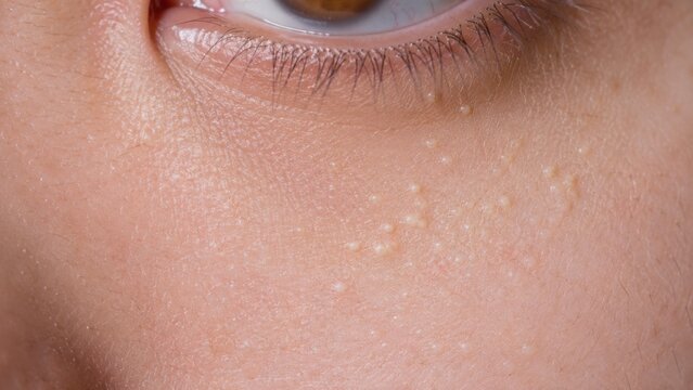 Macro of milia skin condition under human eye