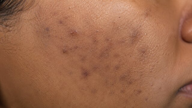Close-up of hyperpigmentation and acne scars on skin