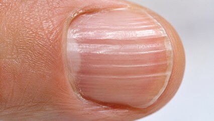 Fototapeta premium Extreme macro of Beau's lines on a human fingernail