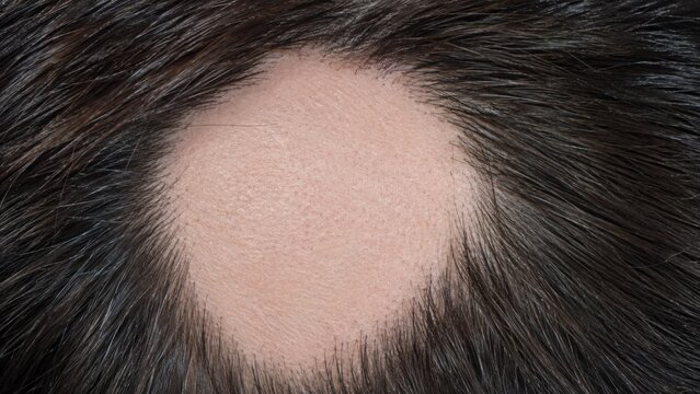 Macro view of alopecia areata bald patch on scalp