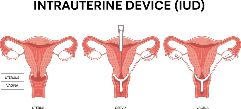 Intrauterine Device IUD Medical Vector Illustration Showing Contraceptive Placement in Female Reproductive System with Uterus Anatomy Healthcare Educational Diagram