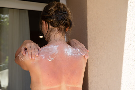 Woman applying panthenol spray to her sunburned back, shoulders after prolonged sun exposure. Soothing irritated skin, relieving discomfort and supporting recovery. Vacation, UV damage, skin health