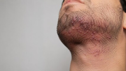 Naklejka premium Close up of red irritated skin with acne and pimples on male chin and jawline with facial hair