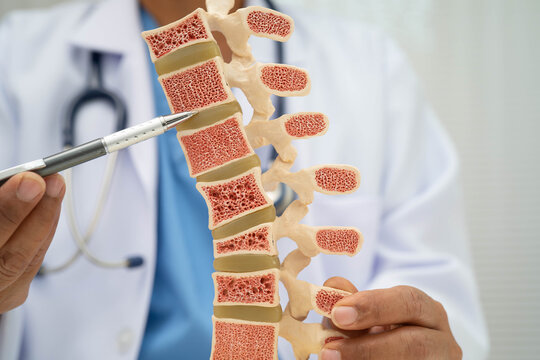 Doctor holding osteoporosis in back bone model for treatment medical in orthopedic department.
