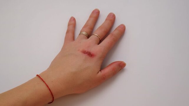 Burn on a woman hand. Selective focus.