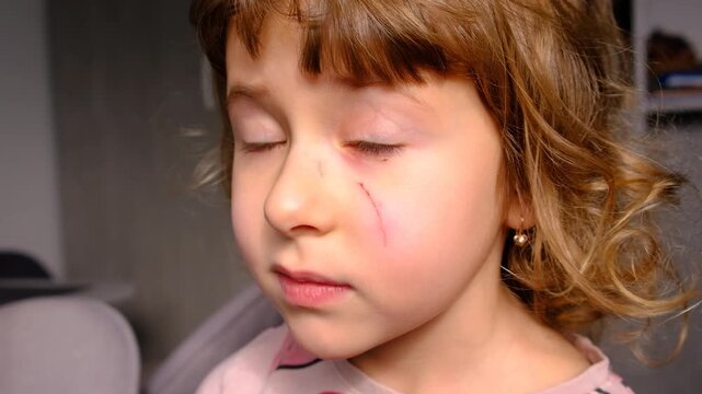 A scratch on a child face. Selective focus.