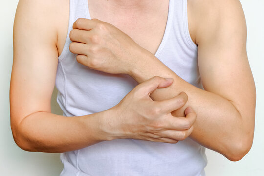 A close-up of a man scratching his itchy arm, depicting skin irritation, allergies, dermatitis, and common dermatological discomforts.concept health care