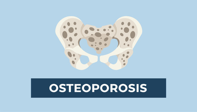 Medical illustration of a human pelvis bone showing signs of low density and holes associated with the condition osteoporosis.
