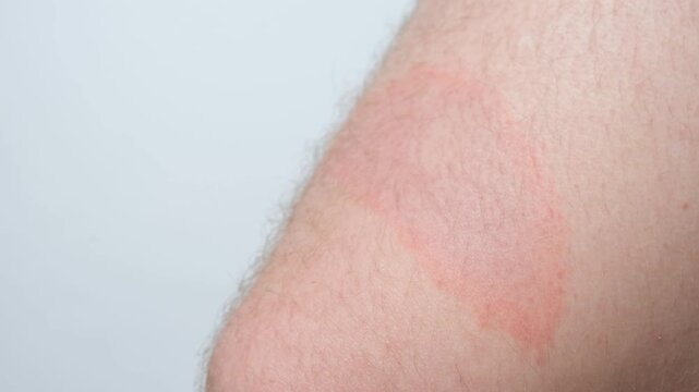 Close-up of circular red skin lesion characteristic of Borreliosis infection after a tick bite.
