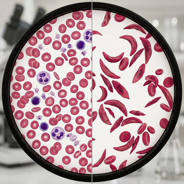 Healthy Blood Cells vs Sickle Cell Disease 3D Medical Illustration of Abnormal Red Blood Cells