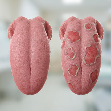 Healthy Tongue vs Geographic Tongue 3D Medical Anatomy Comparison