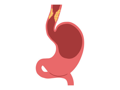 Esophageal Cancer Disease in Stomach