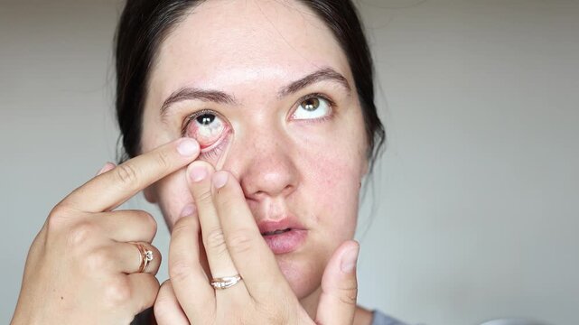 Young woman applies eye ointment under lower eyelid in slow motion. Close up shows red inflamed eye with infection symptoms and medical treatment routine.