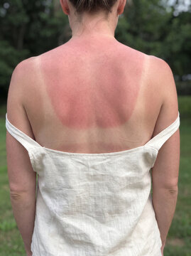 Sunburned Back and Shoulders with Visible Tan Line Contrast on Fair Skin