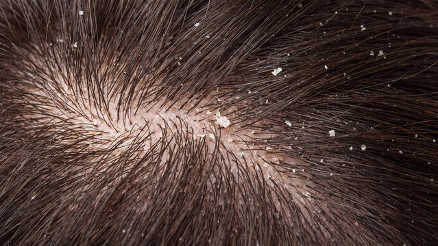 Close view of flaking dandruff on a scalp among hair strands for seborrheic scalp condition diagnosis and antidandruff treatment education