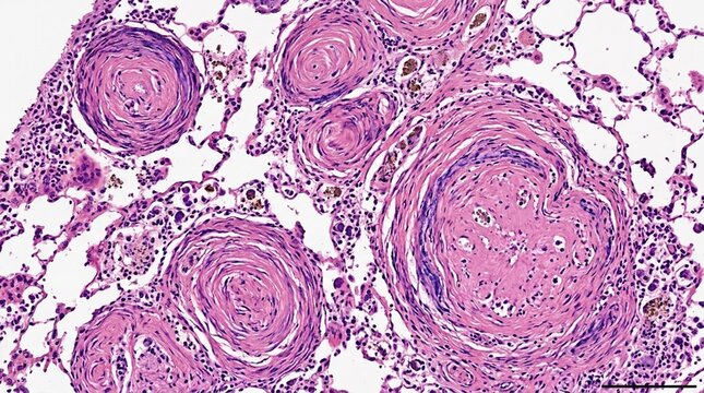 High magnification micrograph of human lung tissue showing asbestos bodies with characteristic whorled appearance, histological staining revealing pathological changes in respiratory disease