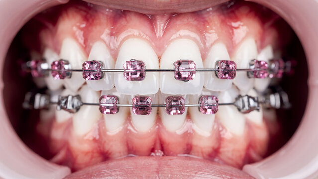 Macro shot of teeth with pink diamond braces and metal wires, close-up, ideal for dental marketing, cosmetic dentistry and orthodontics promotion