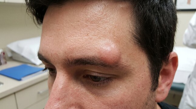Dermoid Cyst of the Skin 