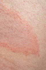Fototapeta premium Close-up of circular red skin lesion characteristic of Borreliosis infection after a tick bite