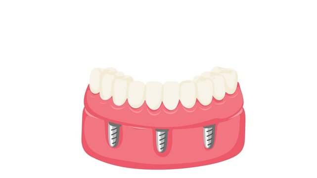 Animation of removable dentures