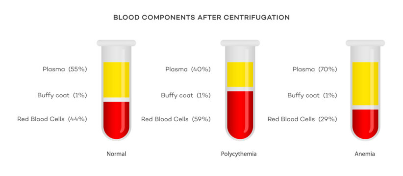 Illustration of blood components after centrifugation, showing percentages for Normal, Polycythemia, and Anemia conditions 55, 1, 44, 40, 59, 70, 29.