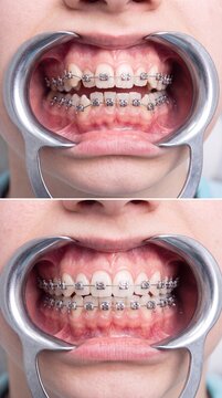 Patient's mouth with a retractor during an orthodontic check-up, showing metal braces on the teeth. Concept of dentistry, hygiene, and the treatment process.