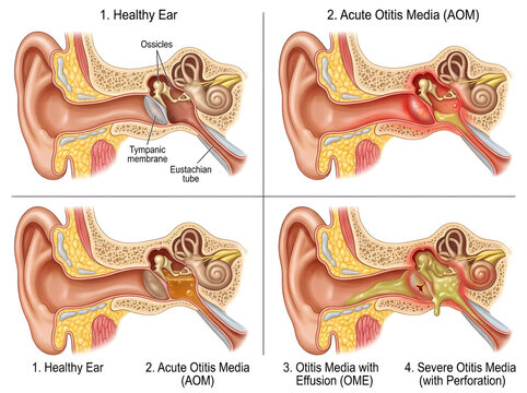 Ear conditions comparison illustration with healthy and diseased states isolated on white background