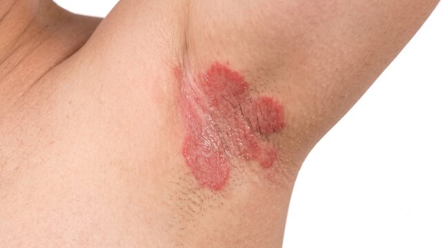 Close up of inverse psoriasis or fungal rash in human armpit