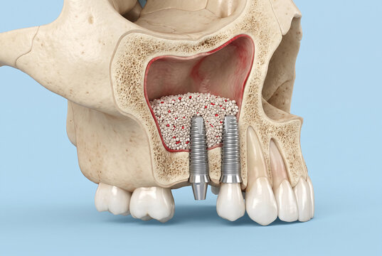 Detailed Anatomical Illustration of Maxilla Sinus Lift with Dental Implants and Bone Graft for Restorative Dentistry Education