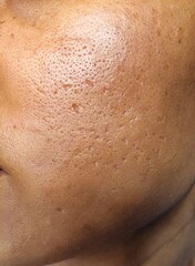 Fototapeta premium Facial skin of a person, showing atrophic acne scars and enlarged pores