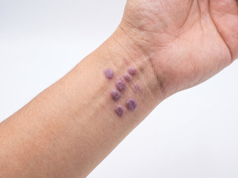 Adult wrist with lichen planus showing purple flat-topped papules on skin, inflammatory autoimmune skin condition dermatology concept