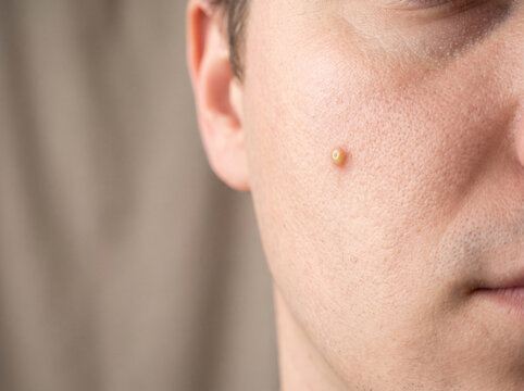 Adult cheek skin with sebaceous hyperplasia showing small yellow dome-shaped bump, benign oil gland skin condition dermatology concept