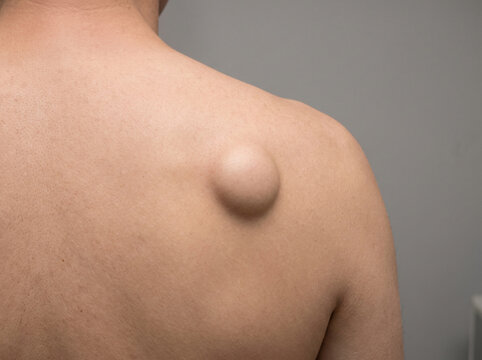 Upper back skin with lipoma showing soft round subcutaneous lump under skin, benign fatty tumor dermatology medical concept