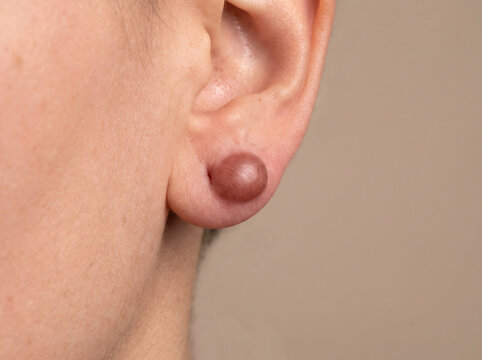 Earlobe with keloid scar showing raised smooth overgrown scar tissue from piercing, abnormal scarring dermatology medical concept