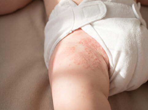 Infant skin with mild diaper rash showing pink red irritated patches, common pediatric skin condition dermatology parenting concept