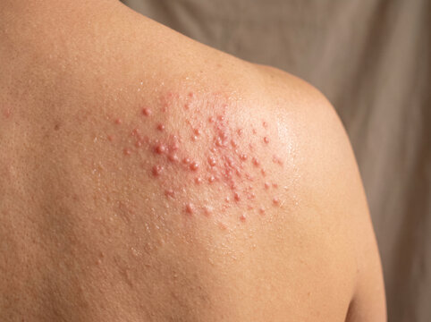 Back skin with miliaria prickly heat rash showing tiny red pinpoint bumps, heat-induced skin condition dermatology summer concept