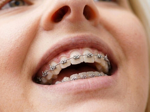 Orthodontic Braces on Healthy Teeth Close-Up Portrait