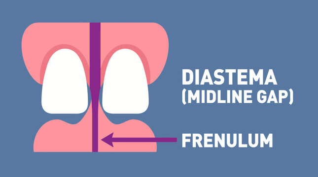 Frenulum Attachment Diastema Midline Gap Diagram